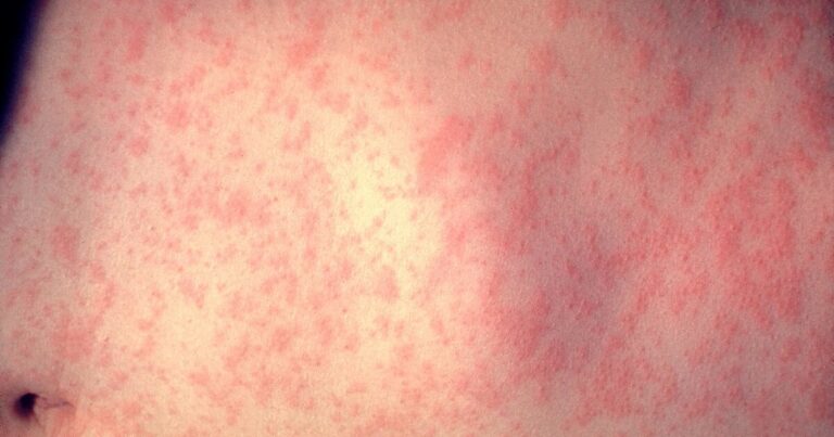 Quarantine orders issued after measles exposure at Monroe private school
