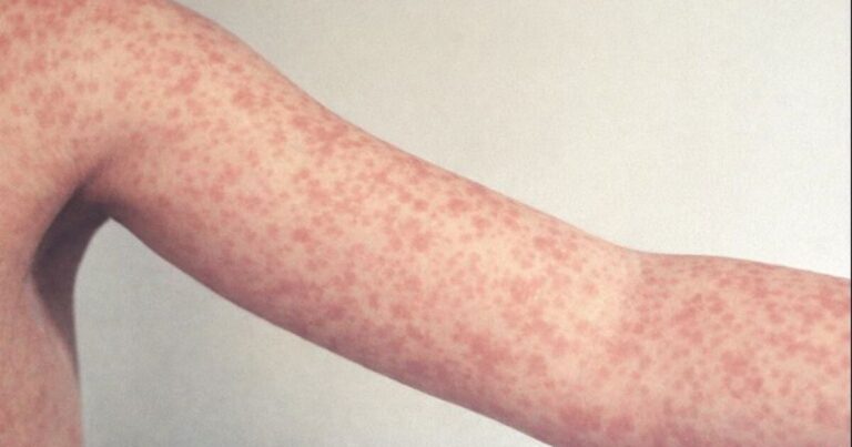Two new measles cases in Buncombe County heighten concern about community spread