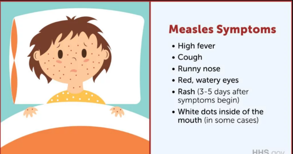 Buncombe County confirms new measles case; exposure sites announced