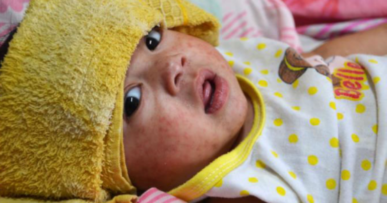 Mecklenburg County issues measles exposure notice for two locations