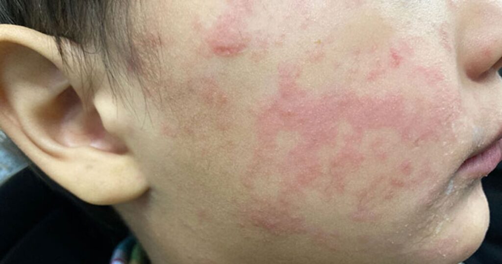 South Carolina declares measles outbreak over after 997 cases