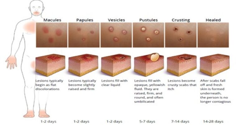 Washoe County Health officials encourage caution amid two mpox cases