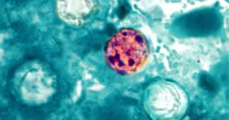 WNC health departments flag cyclosporiasis cases as counts climb statewide